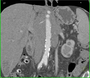 Lymphoma Encases the Pancreas - CTisus CT Scan