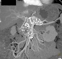 Chronic Pancreatitis - CTisus CT Scan