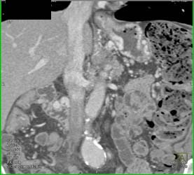 Islet Cell Tumor Encases SMA/celiac and PV-SMV - CTisus CT Scan