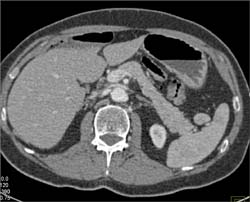 Normal Tail of Pancreas With Accessory Spleen - CTisus CT Scan