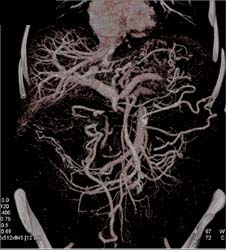 Tumor Encases SMV/PV Confluence - CTisus CT Scan