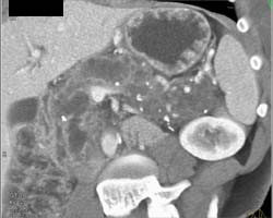 Intraductal Papillary Mucinous Neoplasm (IPMN) Replaces the Entire Gland - CTisus CT Scan