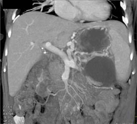 Pseudocyst Occludes the Splenic Vein - CTisus CT Scan