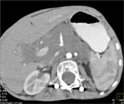 Neurofibromatosis Simulates Tumor-see Spine - CTisus CT Scan