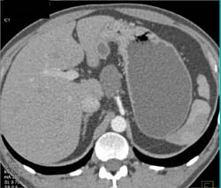 Cystadenoma - CTisus CT Scan