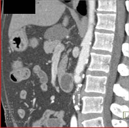 Cystadenoma - CTisus CT Scan