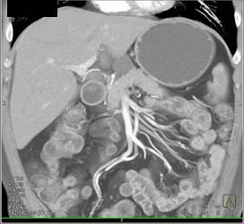 Cystadenoma - CTisus CT Scan