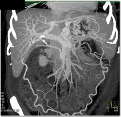 Occlusion of Splenic Vein With Extensive Collaterals - CTisus CT Scan