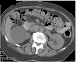 Fatty Replacement of the Pancreas - CTisus CT Scan