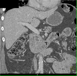 Intraductal Papillary Mucinous Neoplasm (IPMN) - CTisus CT Scan