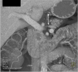 Intraductal Papillary Mucinous Neoplasm (IPMN) - CTisus CT Scan