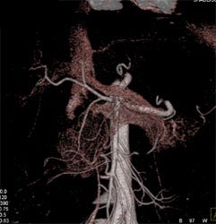 Normal 3D of the Pancreas - CTisus CT Scan