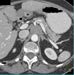 Tumor Encases SMA - CTisus CT Scan