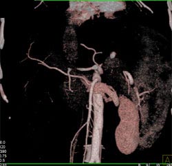 Replaced Right Hepatic of the SMA - CTisus CT Scan