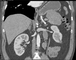 Islet Cell Tumor With Neovascularity on Later Phase Imaging - CTisus CT Scan