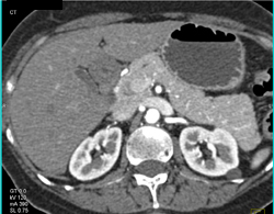 Normal Tail of Pancreas - CTisus CT Scan