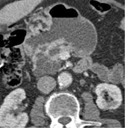 Cystadenoma - CTisus CT Scan