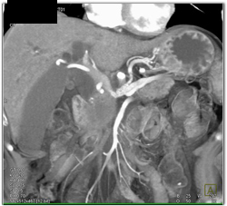 Pancreatic Adenocarcinoma Encases the PV/SMV - CTisus CT Scan