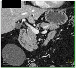 Pancreatic Cancer - CTisus CT Scan