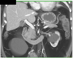 Pancreatic Cancer - CTisus CT Scan