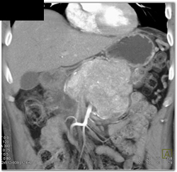 Islet Cell Tumor - CTisus CT Scan