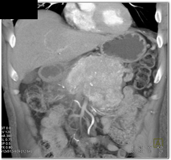 Islet Cell Tumor - CTisus CT Scan