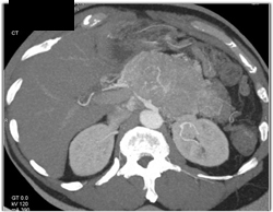 Islet Cell Tumor - CTisus CT Scan