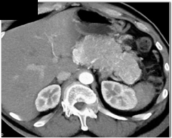 Islet Cell Tumor - CTisus CT Scan