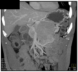 Islet Cell Tumor Encases PV/SMV - CTisus CT Scan