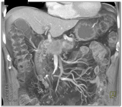 Carcinoma of the Pancreas - CTisus CT Scan