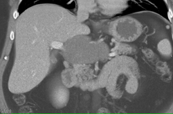 Neurogenic Tumor Simulates A Cystic Tumor - CTisus CT Scan