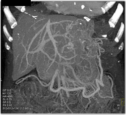 Collaterals Around Liver - CTisus CT Scan