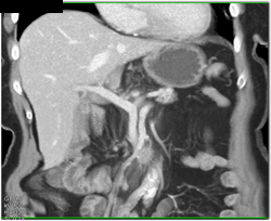 Hepatic Aa Off Single Vessel - CTisus CT Scan