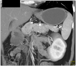 Top Normal Gland - CTisus CT Scan