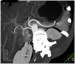 Hepatic Aa Off Aorta - CTisus CT Scan