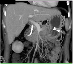 Encased PV/SMV By Tumor - CTisus CT Scan