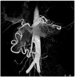 Median Arcuate Ligament Syndrome - CTisus CT Scan