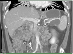 Pseudocyst - CTisus CT Scan