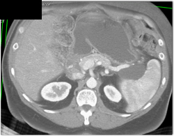 Pseudocyst - CTisus CT Scan