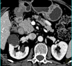 Intraductal Papillary Mucinous Neoplasm (IPMN) - CTisus CT Scan