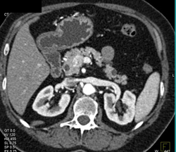 Intraductal Papillary Mucinous Neoplasm (IPMN) - CTisus CT Scan