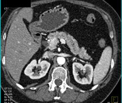 Intraductal Papillary Mucinous Neoplasm (IPMN) - CTisus CT Scan