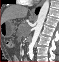 Carcinoma Encases the SMA - CTisus CT Scan