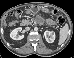 Pancreatic Cancer With Carcinomatosis and Invasion of PV/SMV - CTisus CT Scan