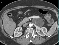 Cystic Mass of Pancreas - CTisus CT Scan