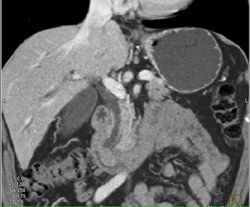 Dilated Common Bile Duct (CBD) With Ampullary Tumor - CTisus CT Scan