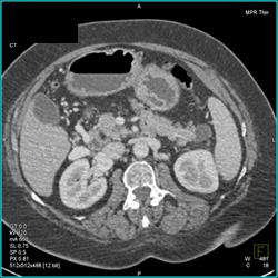 Accessory Spleen Simulates A Cyst in the Tail of Pancreas - CTisus CT Scan