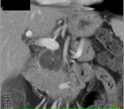 Intraductal Papillary Mucinous Neoplasm (IPMN) - CTisus CT Scan