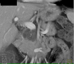 Intraductal Papillary Mucinous Neoplasm (IPMN) - CTisus CT Scan