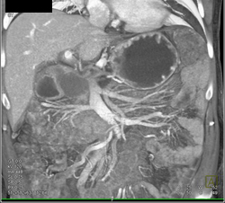 Pseudocyst - CTisus CT Scan